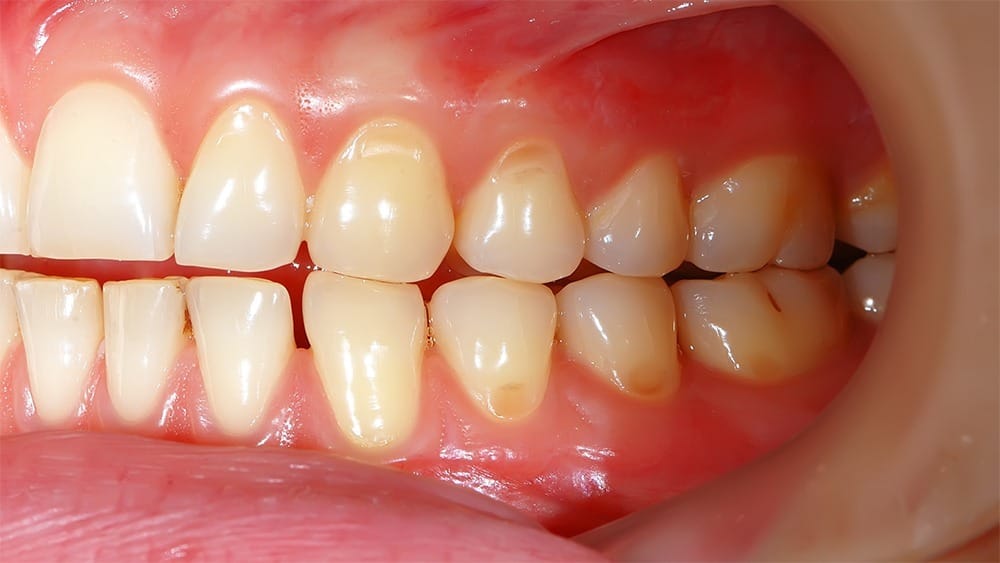 Person holding their jaw, showing tension from clenching and grinding, Geelong