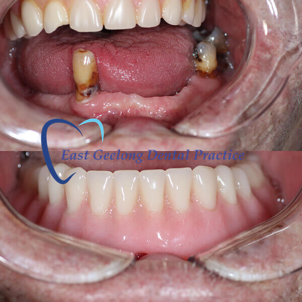 implant-supported-lower-denture