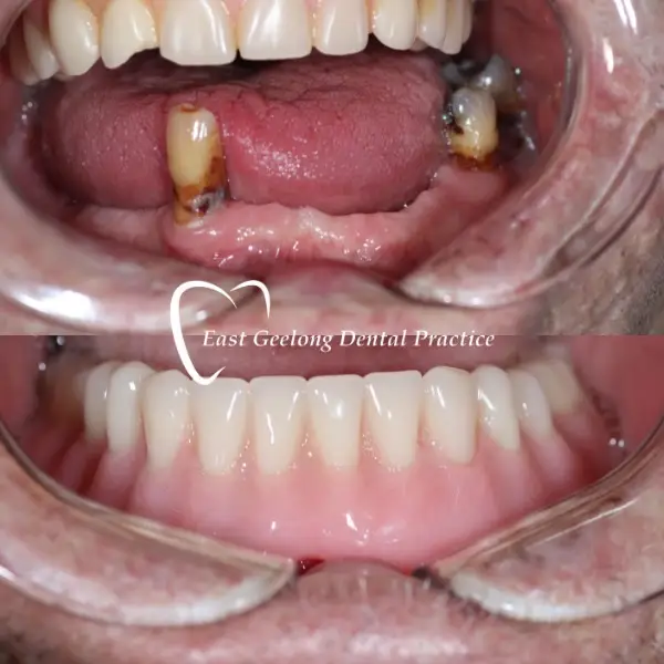 Treatment: Lower Implant-Retained Denture
After photo taken 6 months post-procedure