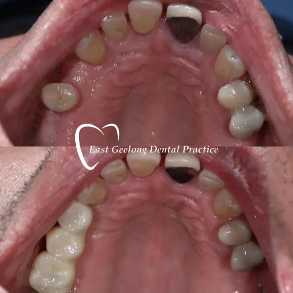 Treatment: Take-home teeth whitening, new bridge, crowns & veneers on upper front six teeth
Treatment Duration: 3 visits over 3 months