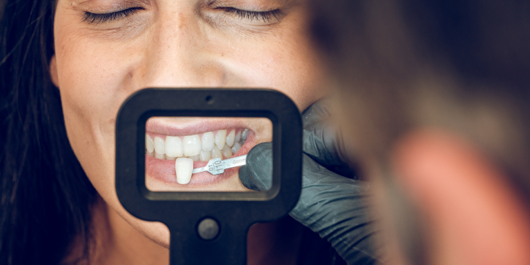 Dentist shade matching a veneer against a patient's teeth in Geelong