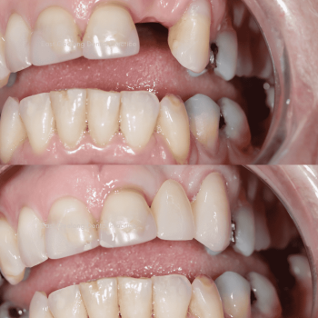 Anterior Bridge