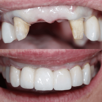 Anterior Bridge
